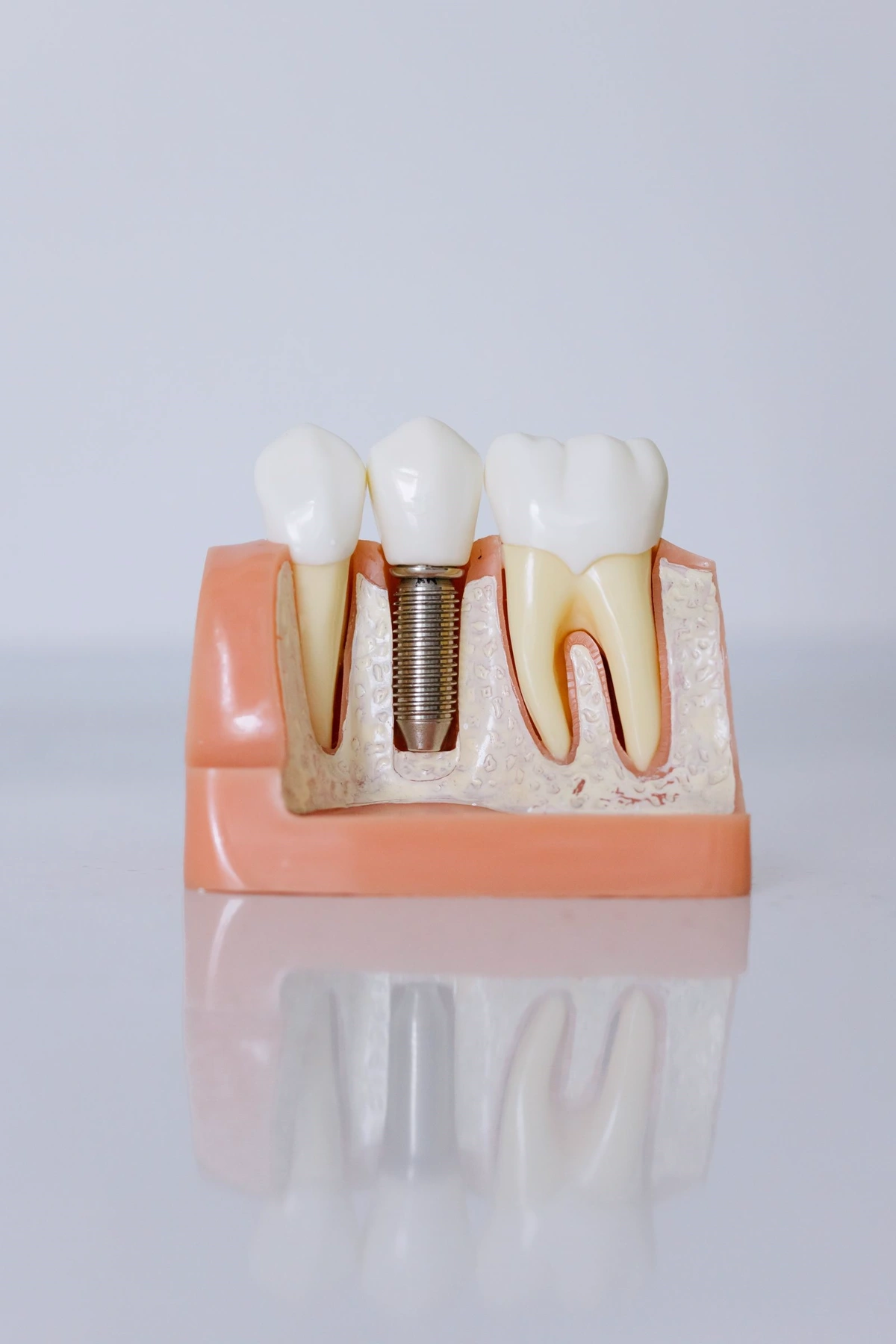 Dental implant model used to explain tooth replacement